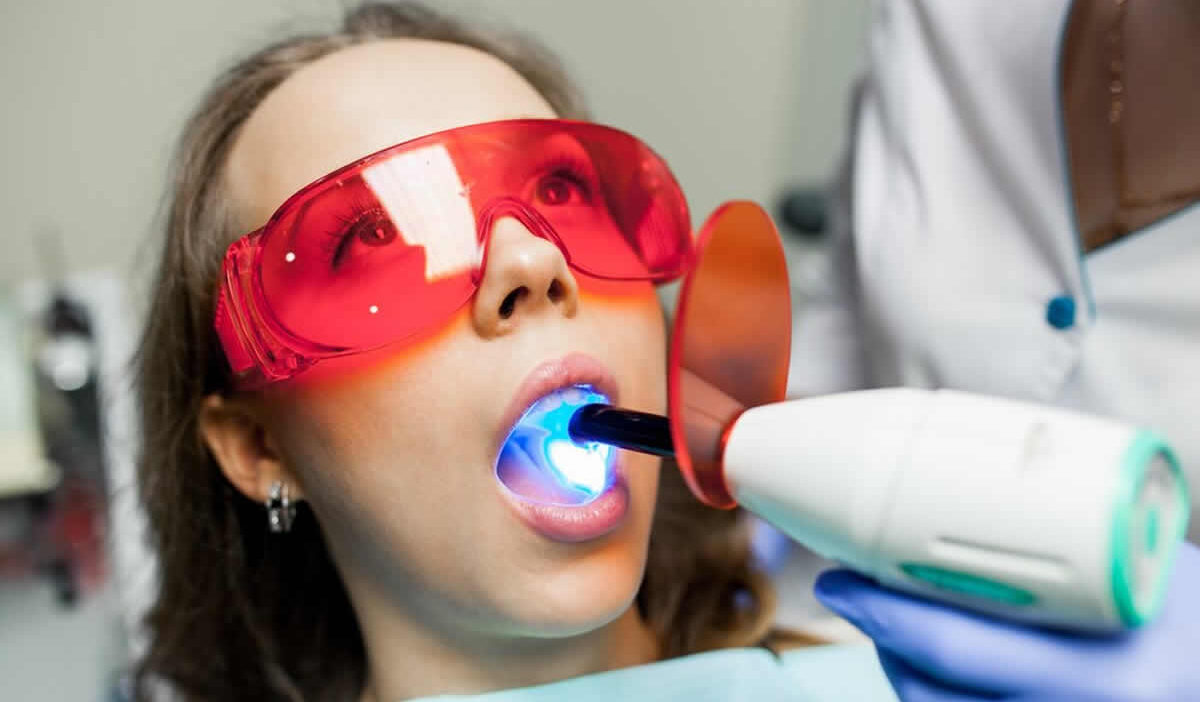 izbjeljivanje zubi cijena bih laser caklina vodikov peroksid zubar stomatolog