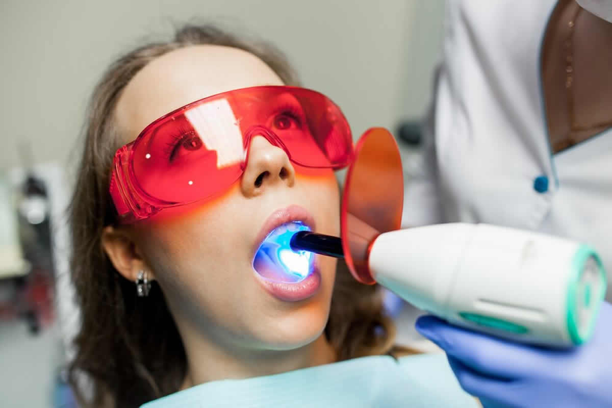 izbjeljivanje zubi cijena bih laser caklina vodikov peroksid zubar stomatolog